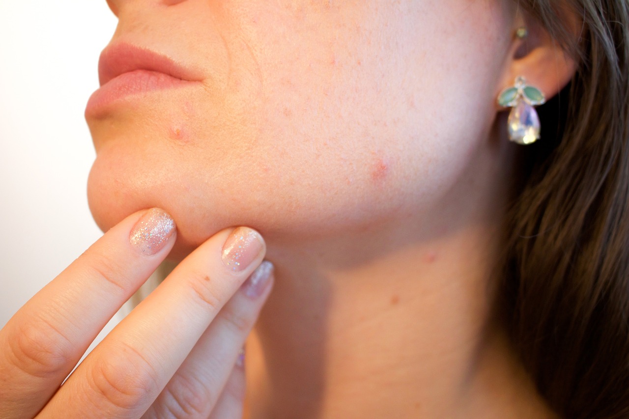 Was hilft gegen verstopfte Poren – Effektive Tipps gegen verstopfte Poren